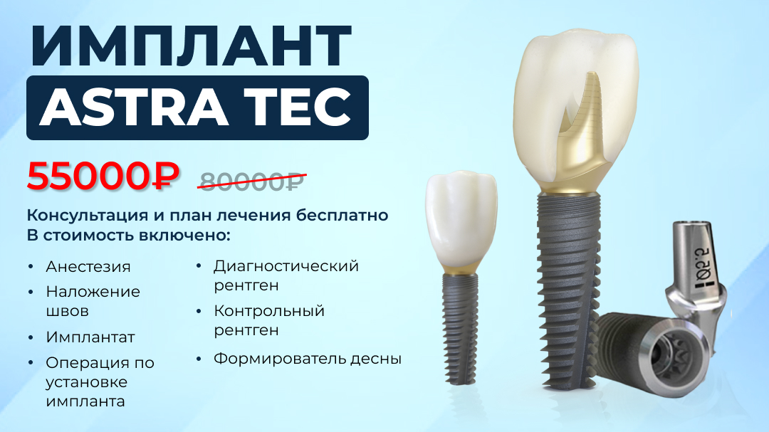 Имплант Astra Tech